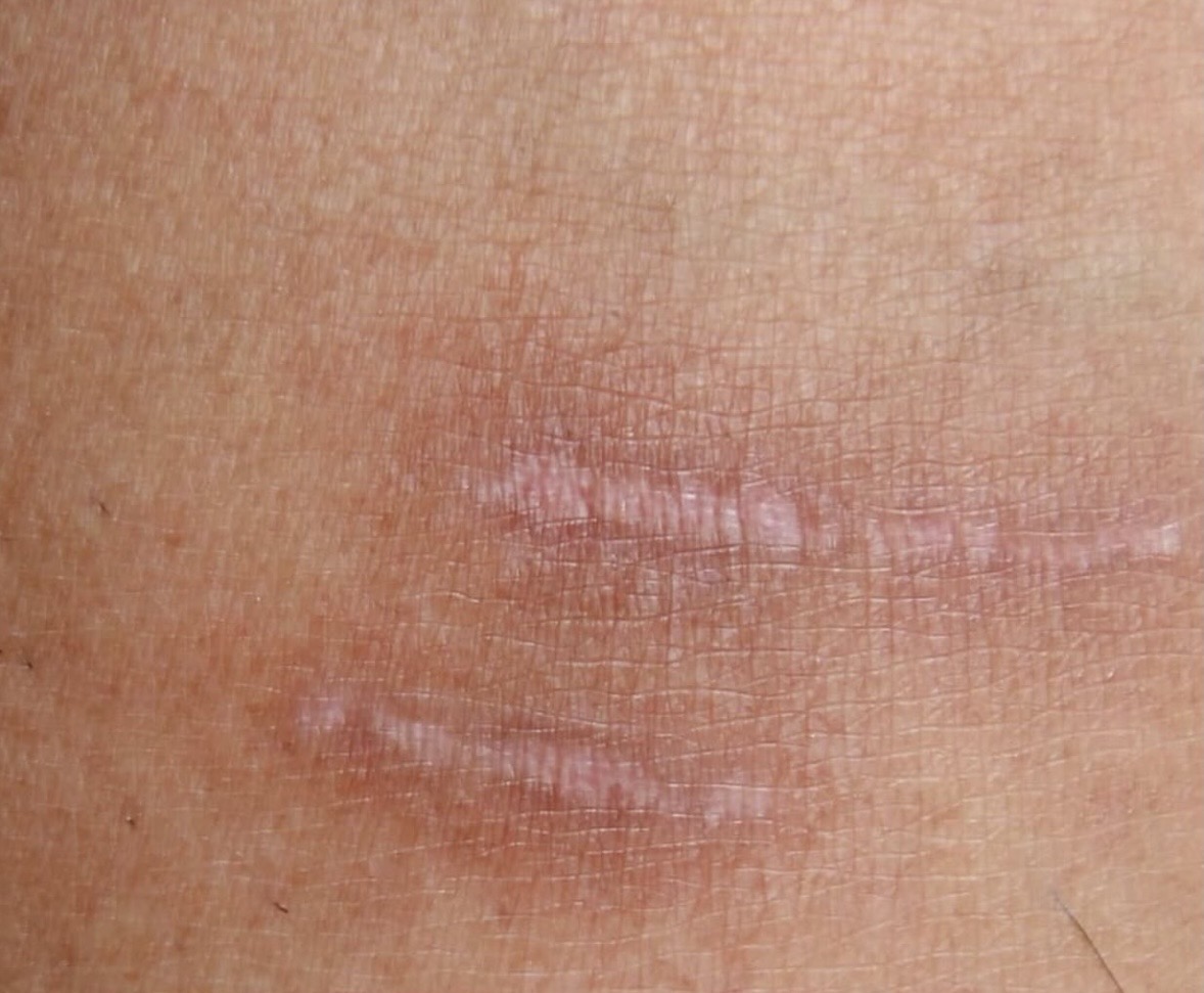 Scar Camouflage