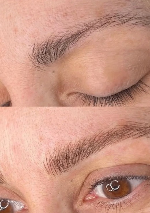 Brow Enhancement